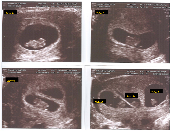 abortion at 8 weeks. Aborted+fetus+at+8+weeks